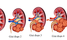 Các lựa chọn điều trị ung thư thận