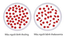 Vì sao cần xét nghiệm gen Thalassemia?