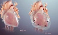 Viêm màng ngoài tim: Nguyên nhân, triệu chứng, cách điều trị và phòng ngừa