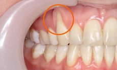 Tụt lợi có chữa được không?