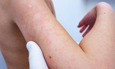 Rôm sảy: Nguyên nhân, triệu chứng, phòng ngừa và điều trị