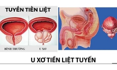 6 cách phòng u xơ tiền liệt tuyến cần biết