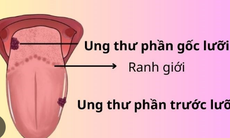 Người bệnh ung thư lưỡi nên tập luyện như thế nào?