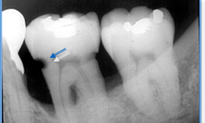 Các phương pháp điều trị sâu răng