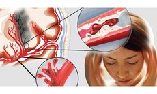 Vì sao đột quỵ gia tăng ở người trẻ?