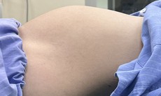 Bất ngờ phát hiện khối u nang buồng trứng lớn như thai nhi 7 tháng trong bụng thiếu nữ
