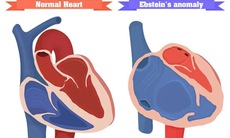 Tim bẩm sinh Ebstein: Nguyên nhân, triệu chứng, cách điều trị