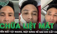 Mặt sưng nề sau khi cấy chỉ chữa liệt mặt ở phòng khám tư 