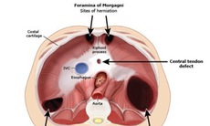 Câu hỏi thường gặp liên quan đến bệnh thoát vị hoành ở trẻ em