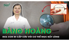 Bàng hoàng: Đưa con đi cấp cứu với cơ thể mọc đầy lông