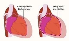 Câu hỏi thường gặp liên quan đến bệnh viêm màng ngoài tim