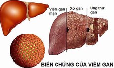 Chuyên gia khuyến cáo gì về căn bệnh là 'sát thủ thầm lặng', nhiều người mắc không biết