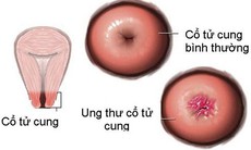 Người bệnh ung thư tử cung nên vận động như thế nào?