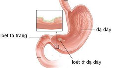 Viêm loét dạ dày có thành ung thư không?