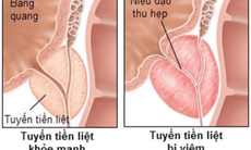 Viêm tuyến tiền liệt là gì, nguyên nhân, triệu chứng và cách chữa trị