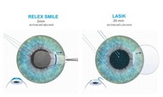 Tìm hiểu về các phương pháp mổ cận