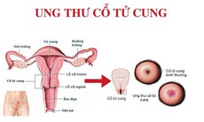 Nhiễm HPV có gây ung thư cổ tử cung?