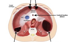 Thoát vị hoành ở trẻ em: Nguyên nhân, triệu chứng, chẩn đoán và điều trị