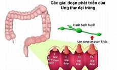 Ung thư đại tràng: Nguyên nhân, biểu hiện, cách điều trị và phòng bệnh