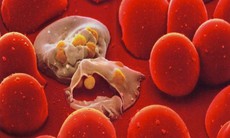 Tan máu bẩm sinh (Thalassemia): Nguyên nhân, triệu chứng và cách điều trị bệnh