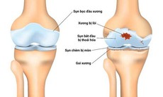 Các phương pháp điều trị thoái hóa khớp gối