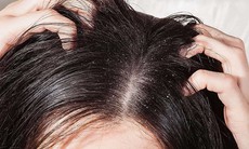 Viêm da tiết bã da đầu gây gàu nhiều, dễ tái phát kéo dài