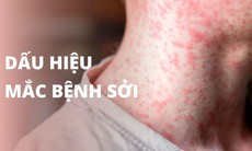 Bệnh sởi bùng phát mạnh, cần làm gì để phòng bệnh cho trẻ?