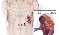 Thuốc và các phương pháp điều trị chấn thương lách