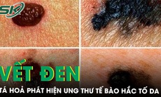 Chủ quan vết đen trên da, đi khám tá hỏa phát hiện ung thư tế bào hắc tố 