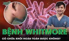 Bệnh whitmore có chữa khỏi hoàn toàn được không?