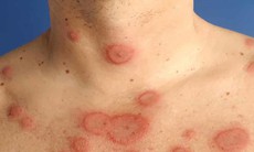 Biểu hiện của lupus ban đỏ như thế nào?