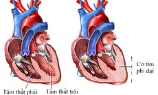 Các thuốc điều trị bệnh cơ tim phì đại