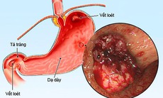 Các thuốc điều trị loét dạ dày tá tràng