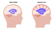 Não úng thủy: Nguyên nhân, triệu chứng, phòng ngừa và cách điều trị