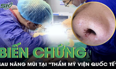 Mũi chảy dịch, biến chứng sau khi nâng mũi tại 'thẩm mỹ viện quốc tế'