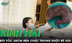 Phẫu thuật lấy búi tóc 20cm quấn lẫn đồ chơi bện chặt trong ruột bé gái 4 tuổi
