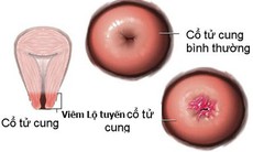 Làm sao để biết có bị viêm lộ tuyến cổ tử cung?