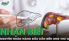 Nhận biết căn bệnh là nguyên nhân hàng đầu dẫn đến ung thư gan 