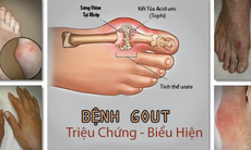 Bệnh gout trẻ hoá: Biểu hiện cần biết, điều trị thế nào?