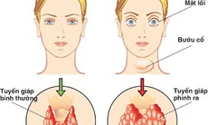 Nguyên nhân, triệu chứng của bướu tuyến giáp và biện pháp cải thiện