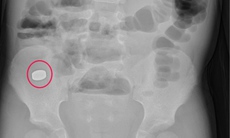 Trẻ 5 tuổi nuốt cục nam châm trong đồ chơi