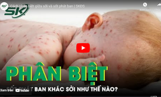 Cách phân biệt giữa sởi và sốt phát ban