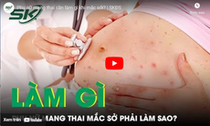 Phụ nữ mang thai cần làm gì khi mắc sởi?