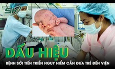 Dấu hiệu bệnh sởi tiến triển nguy hiểm cha mẹ cần đưa trẻ đến viện ngay