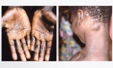 Chủng virus 'chết chóc' hơn của đậu mùa khỉ đang gây lo ngại