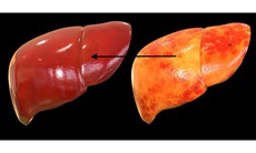 Những thói quen khiến bạn nhanh mắc gan nhiễm mỡ