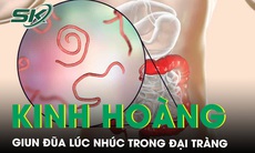 Kinh hoàng hàng chục con giun đũa dài hơn 10cm lúc nhúc trong đại tràng người đàn ông