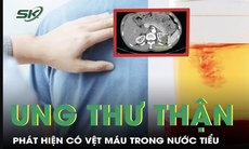 Bàng hoàng phát hiện ung thư thận từ dấu hiệu lạ trong nước tiểu