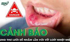 Ung thư bờ lưỡi dễ bị nhầm lẫn với vết loét nhiệt miệng