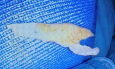 Bé 8 tuổi bị mảnh xương gà sắc nhọn cắm sâu trong thực quản